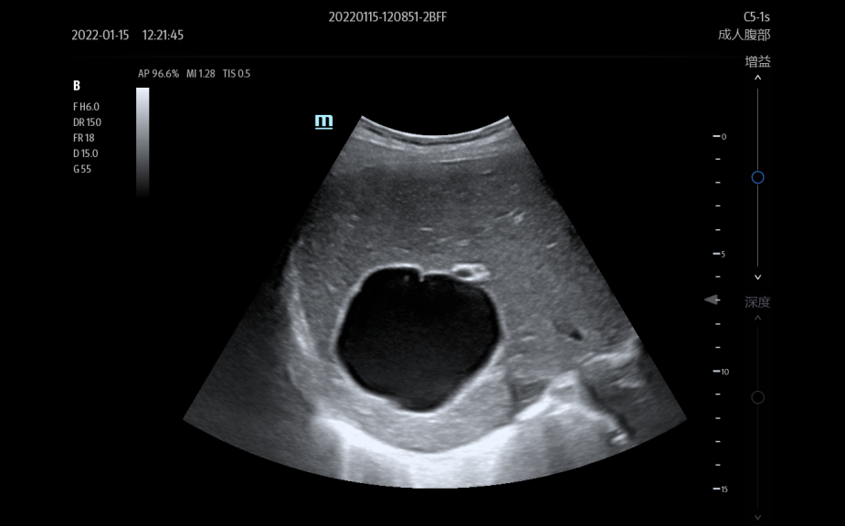 C5-1s_Liver_ Cyst_2D-925x576